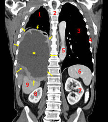 220px-Tumor_Mesothelioma2_legend